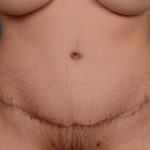 Tummy Tuck Before & After Patient #1811