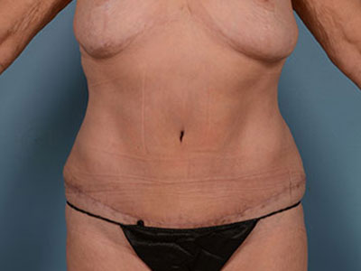 Tummy Tuck Before & After Patient #1965