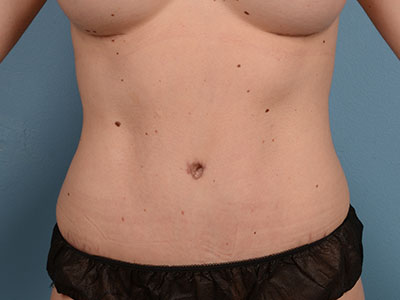 Tummy Tuck Before & After Patient #2086