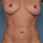 Vaser Liposuction Before & After Patient #2152