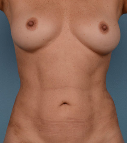 Vaser Liposuction Before & After Patient #2152