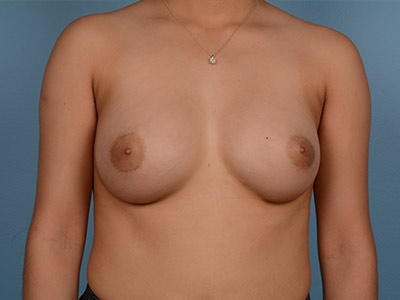 Breast Augmentation Before & After Patient #2609