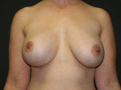 Breast Augmentation Before & After Patient #2675