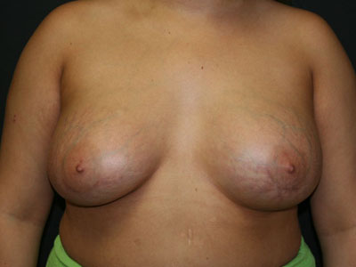Breast Augmentation Before & After Patient #2697