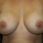 Breast Augmentation Before & After Patient #2720