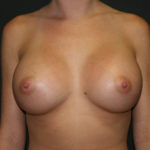 Breast Augmentation Before & After Patient #2788