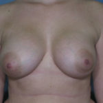 Breast Augmentation Before & After Patient #2891