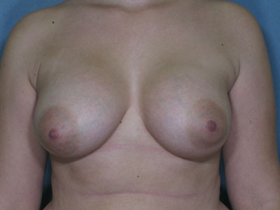 Breast Augmentation Before & After Patient #2891