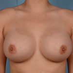 Breast Augmentation Before & After Patient #2980