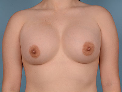 Breast Augmentation Before & After Patient #3030
