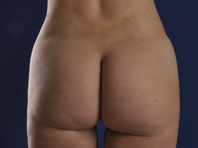 Vaser Liposuction Before & After Patient #784
