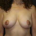 Breast Lift Before & After Patient #3196
