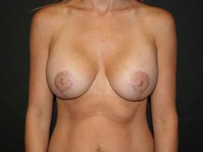 Breast Lift with Augmentation Before & After Patient #3224