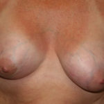 Breast Lift Before & After Patient #3240