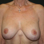 Breast Lift Before & After Patient #3244