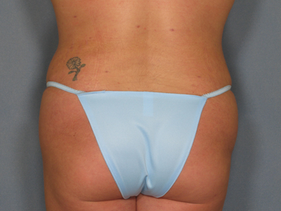 Liposuction Before & After Patient #795