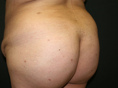 Vaser Liposuction Before & After Patient #798