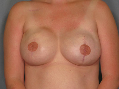 Breast Reconstruction Before & After Patient #3397