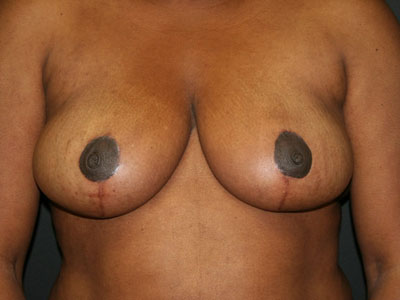 Breast Reduction Before & After Patient #3416
