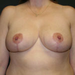 Breast Reduction Before & After Patient #3430