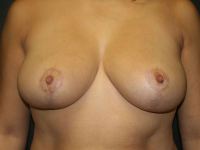 Breast Reduction Before & After Patient #3436