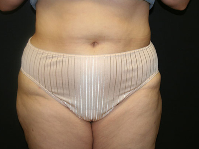 Liposuction Before & After Patient #802
