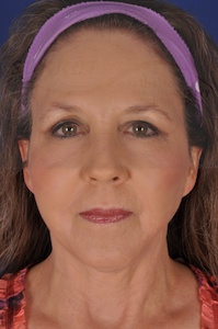 Face & Neck Lift Before & After Patient #4144