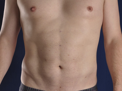 Male Liposuction Before & After Patient #911