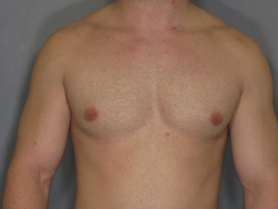 Male Liposuction Before & After Patient #922