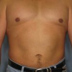 Male Liposuction Before & After Patient #926
