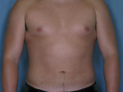 Male Liposuction Before & After Patient #932