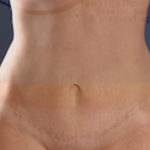 Mini Tummy Tuck Before & After Patient #959