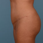 Brazilian Butt Lift Before & After Patient #543