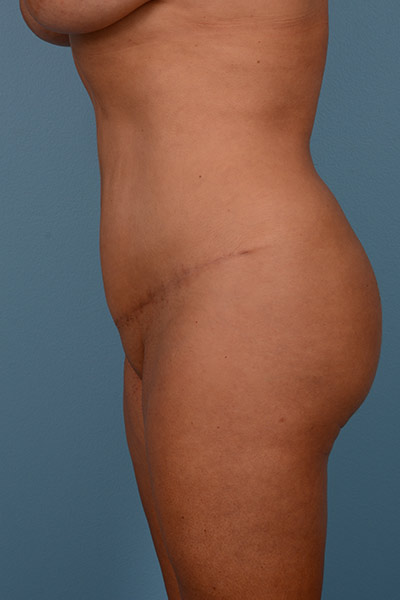 Brazilian Butt Lift Before & After Patient #543