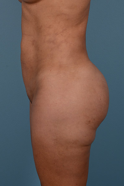 Brazilian Butt Lift (BBL) Before & After Patient #555