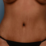 Tummy Tuck Before & After Patient #1263