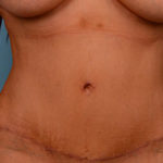 Tummy Tuck Before & After Patient #1274