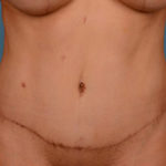Tummy Tuck Before & After Patient #1281