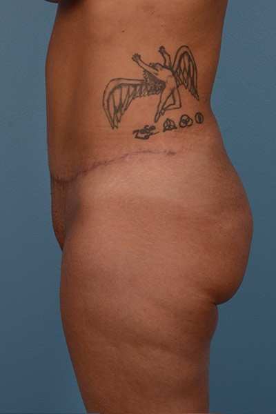Brazilian Butt Lift Before & After Patient #568