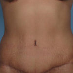 Tummy Tuck Before & After Patient #1333
