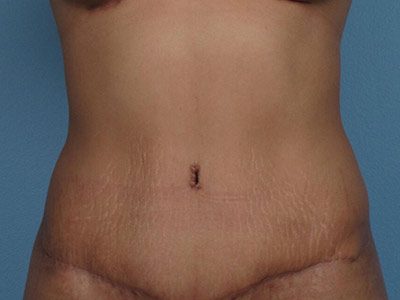 Tummy Tuck Before & After Patient #1333