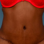 Tummy Tuck Before & After Patient #1355