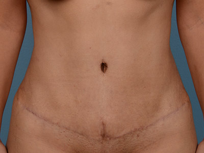 Tummy Tuck Before & After Patient #1394