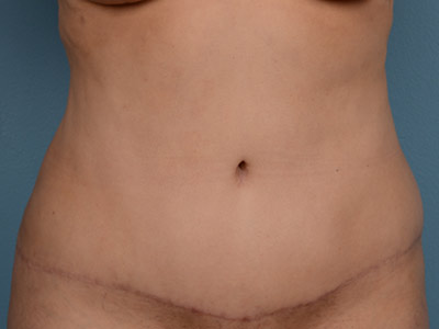 Tummy Tuck Before & After Patient #1408