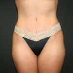 Tummy Tuck Before & After Patient #1519