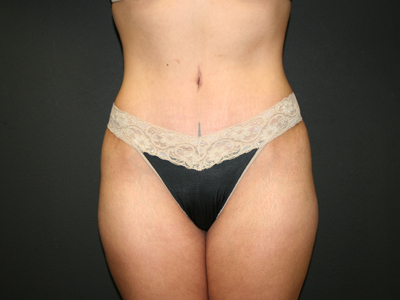 Tummy Tuck Before & After Patient #1519