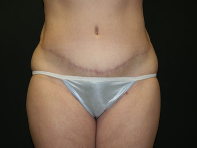 Tummy Tuck Before & After Patient #1554