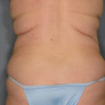 Tummy Tuck Before & After Patient #1657