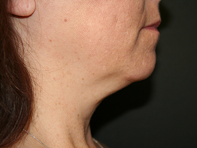 Neck (Submental) Liposuction Before & After Patient #1911
