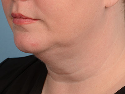 Face & Neck Liposuction Before & After Patient #1959